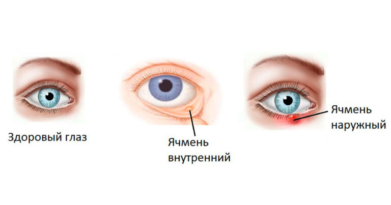 Ячмень на глазу: психосоматические причины и лечение